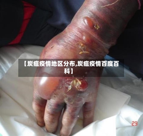 【炭疽疫情地区分布,炭疽疫情百度百科】-第2张图片