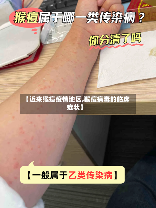 【近来猴痘疫情地区,猴痘病毒的临床症状】-第2张图片